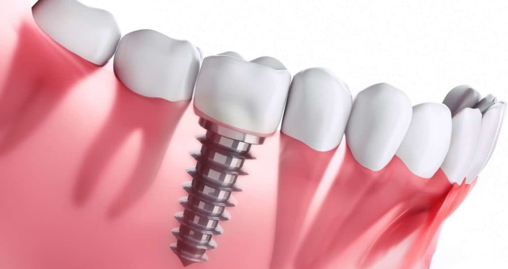 Implants Dentaires à Sassenage - Dr Heni KHELIFI - Sassenage, proche de Fontaine et Grenoble